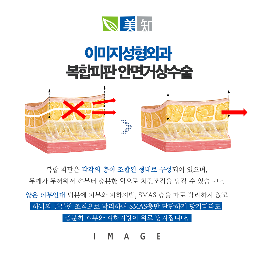 안면거상 회복기간