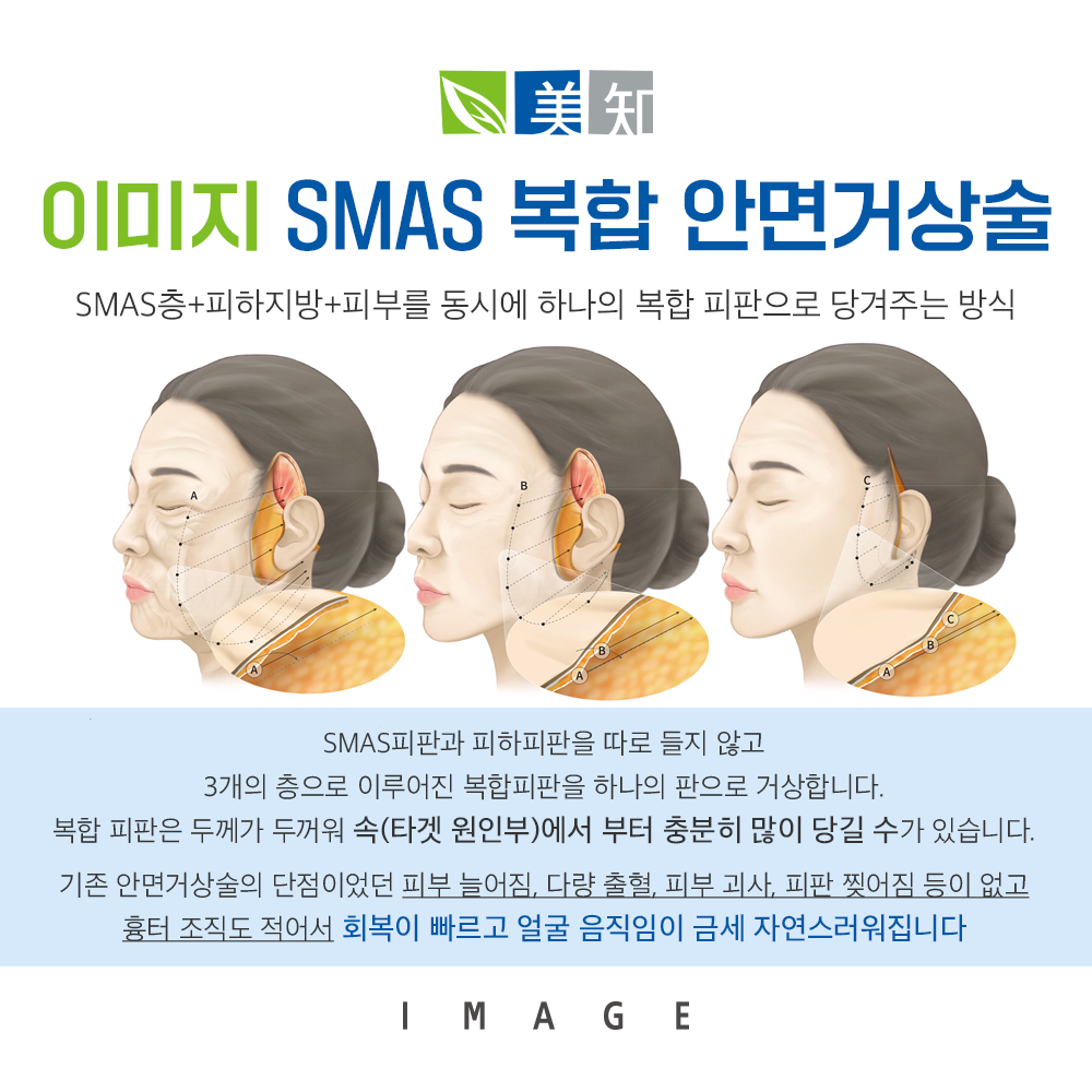 안면거상 부작용