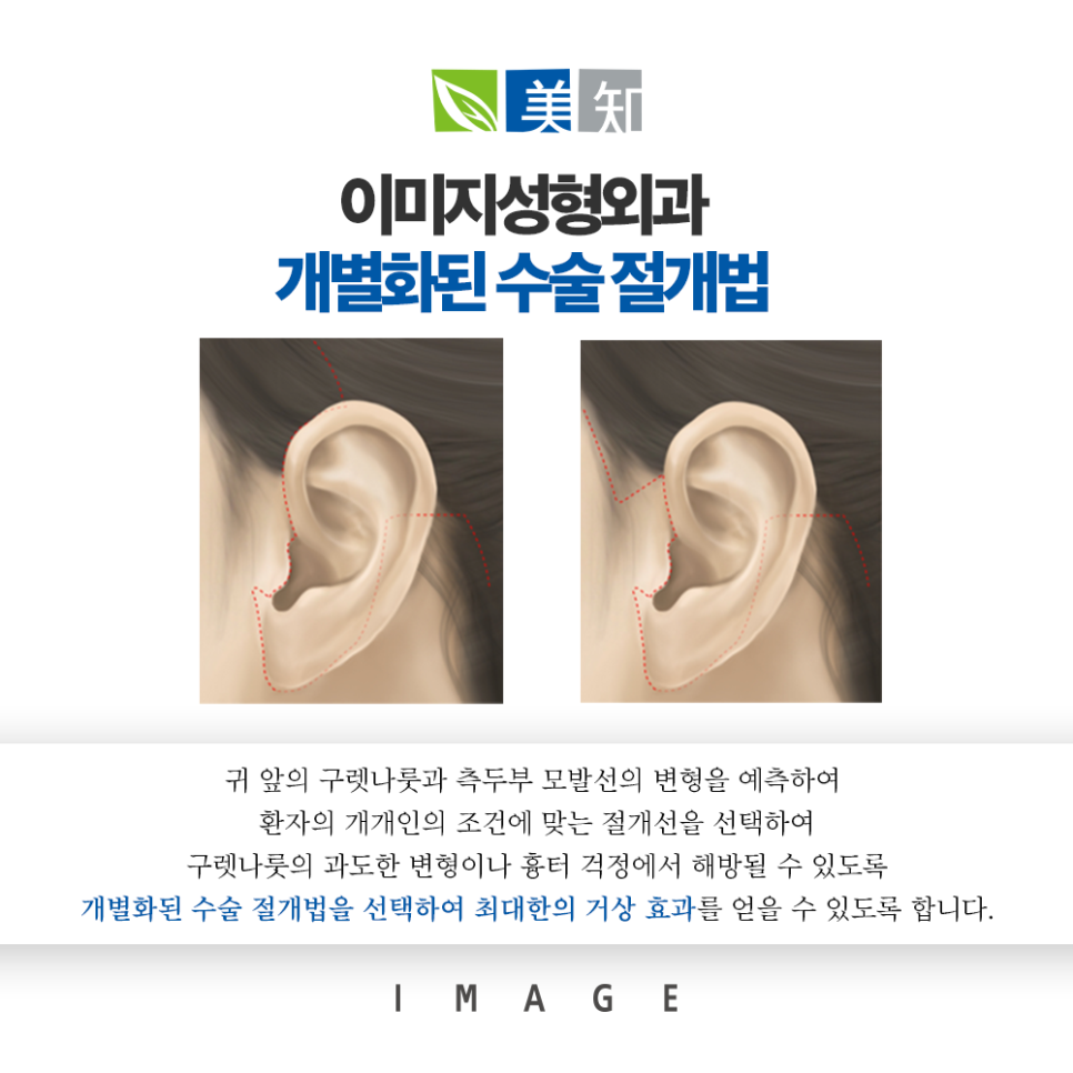 안면거상술 흉터