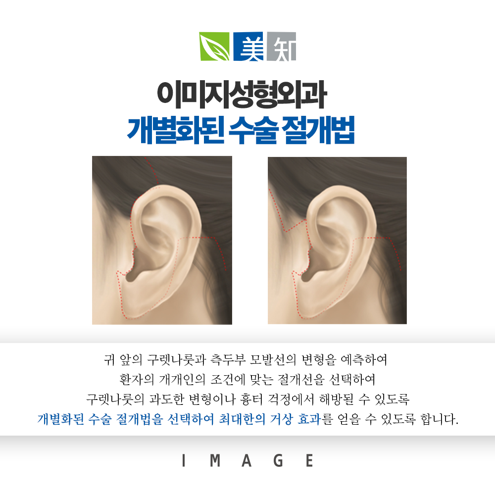 안면거상 회복기간