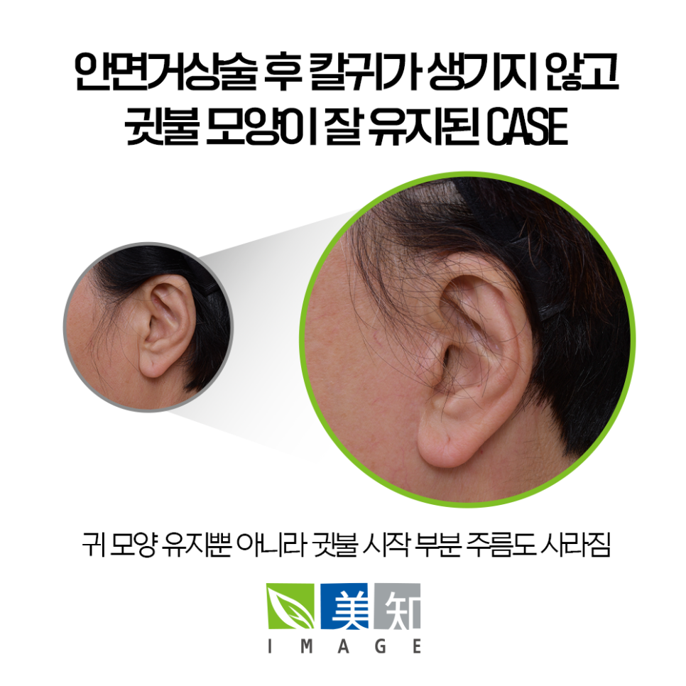 안면거상 칼귀 흉터