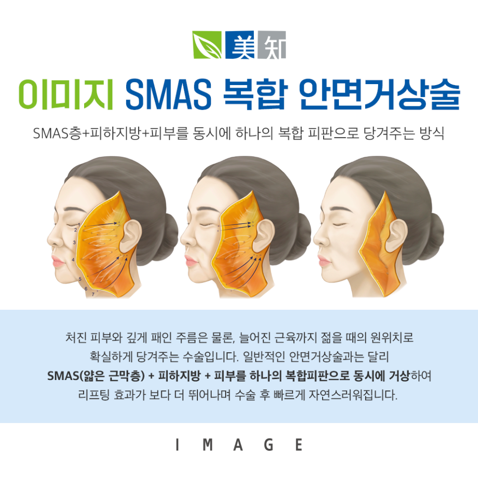 안면거상 칼귀 흉터