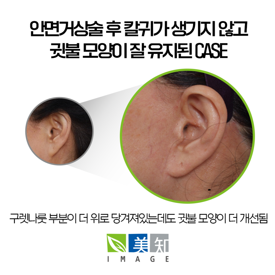 안면거상 칼귀 흉터