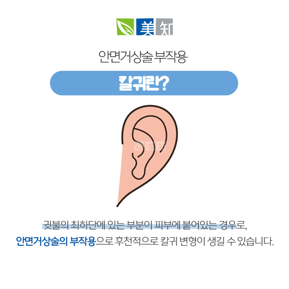 안면거상 칼귀 흉터