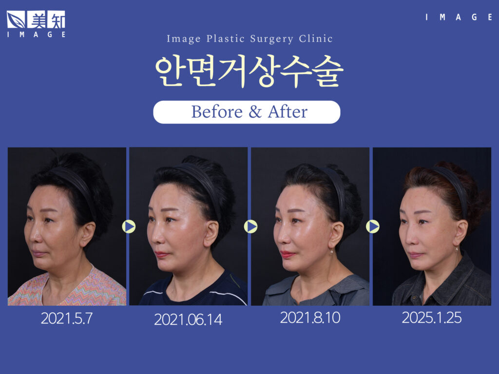 안면거상수술 효과