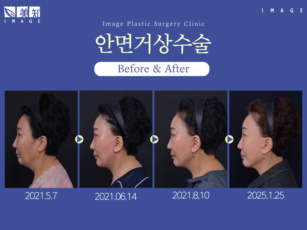 안면거상수술 효과