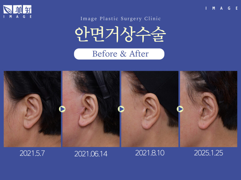 안면거상수술 효과