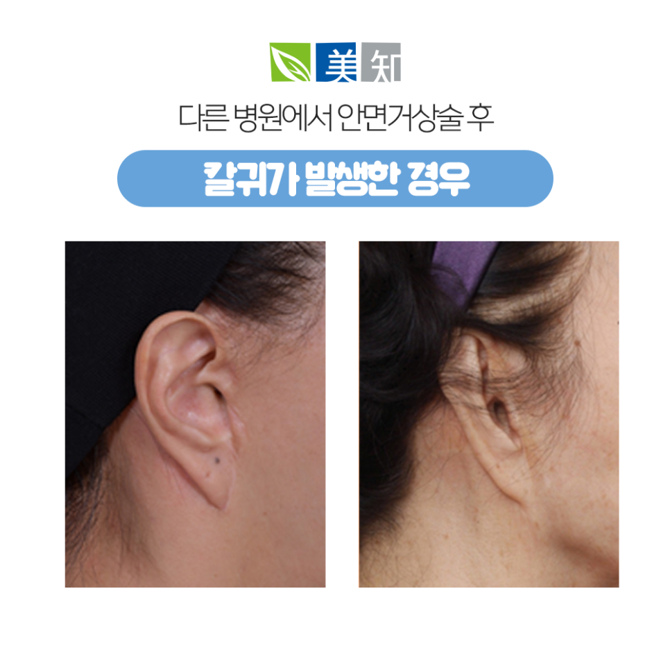 안면거상 칼귀 흉터