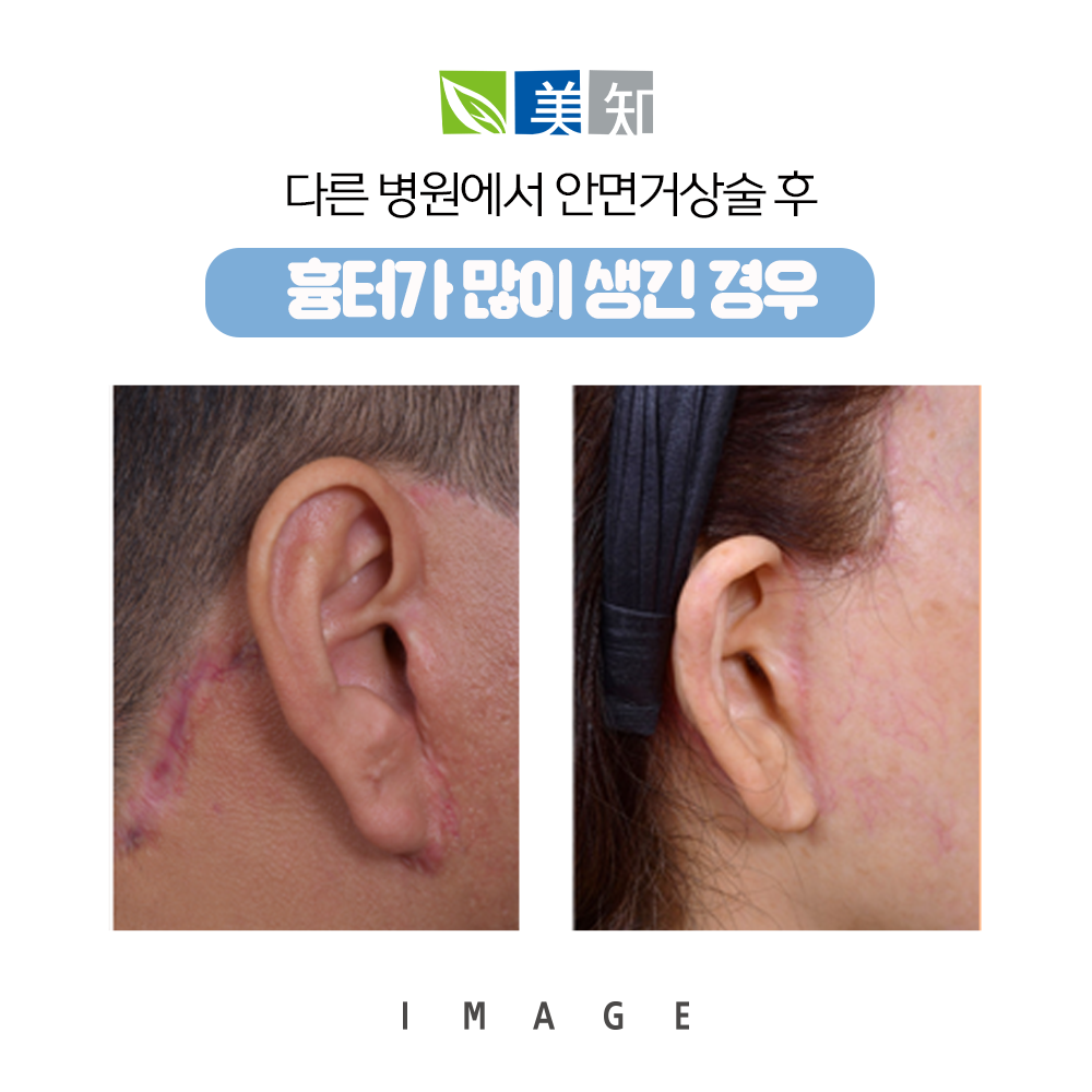 안면거상술 흉터