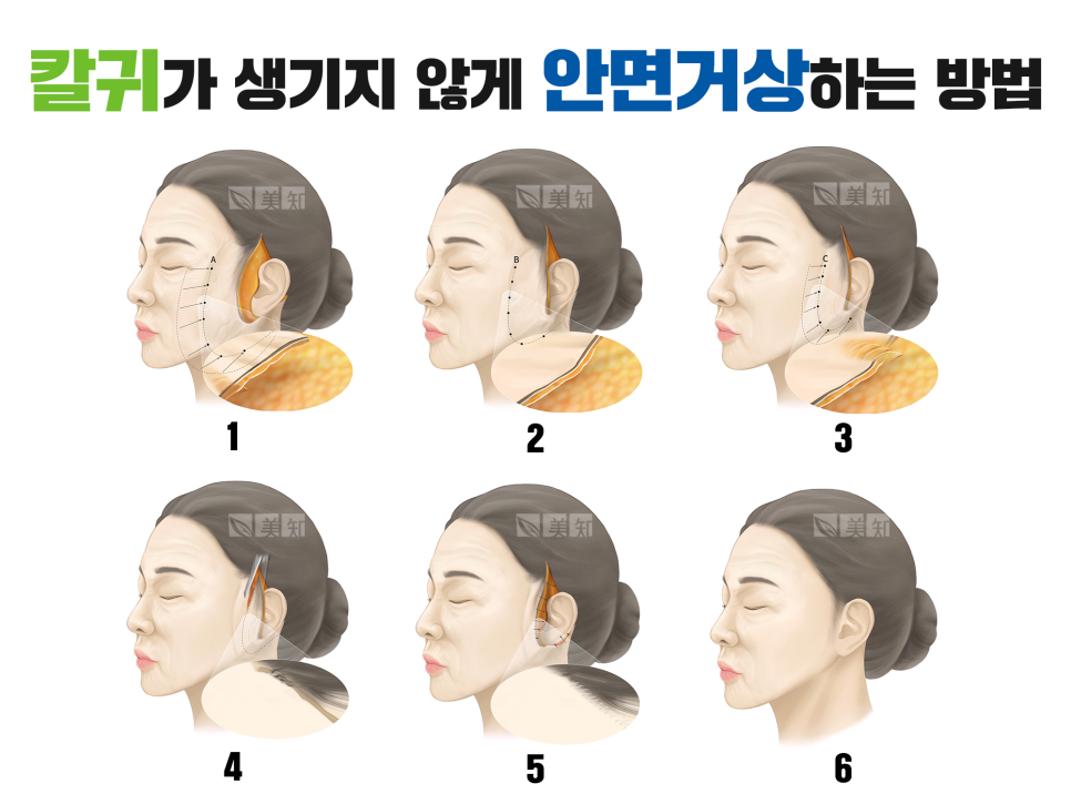 안면거상 칼귀 흉터