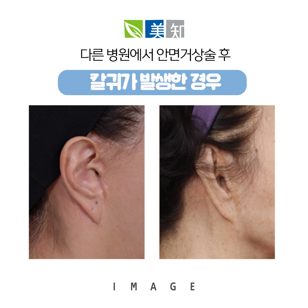 안면거상술 흉터