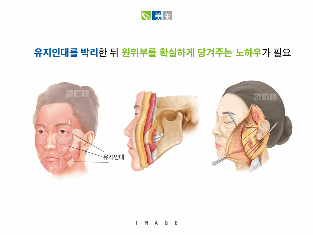 안면거상 부작용