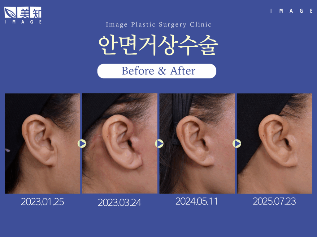 안면거상술 흉터