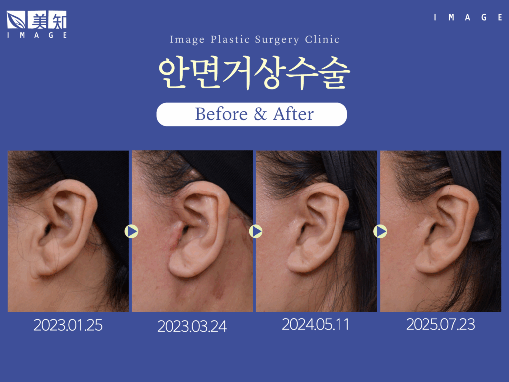 안면거상술 흉터