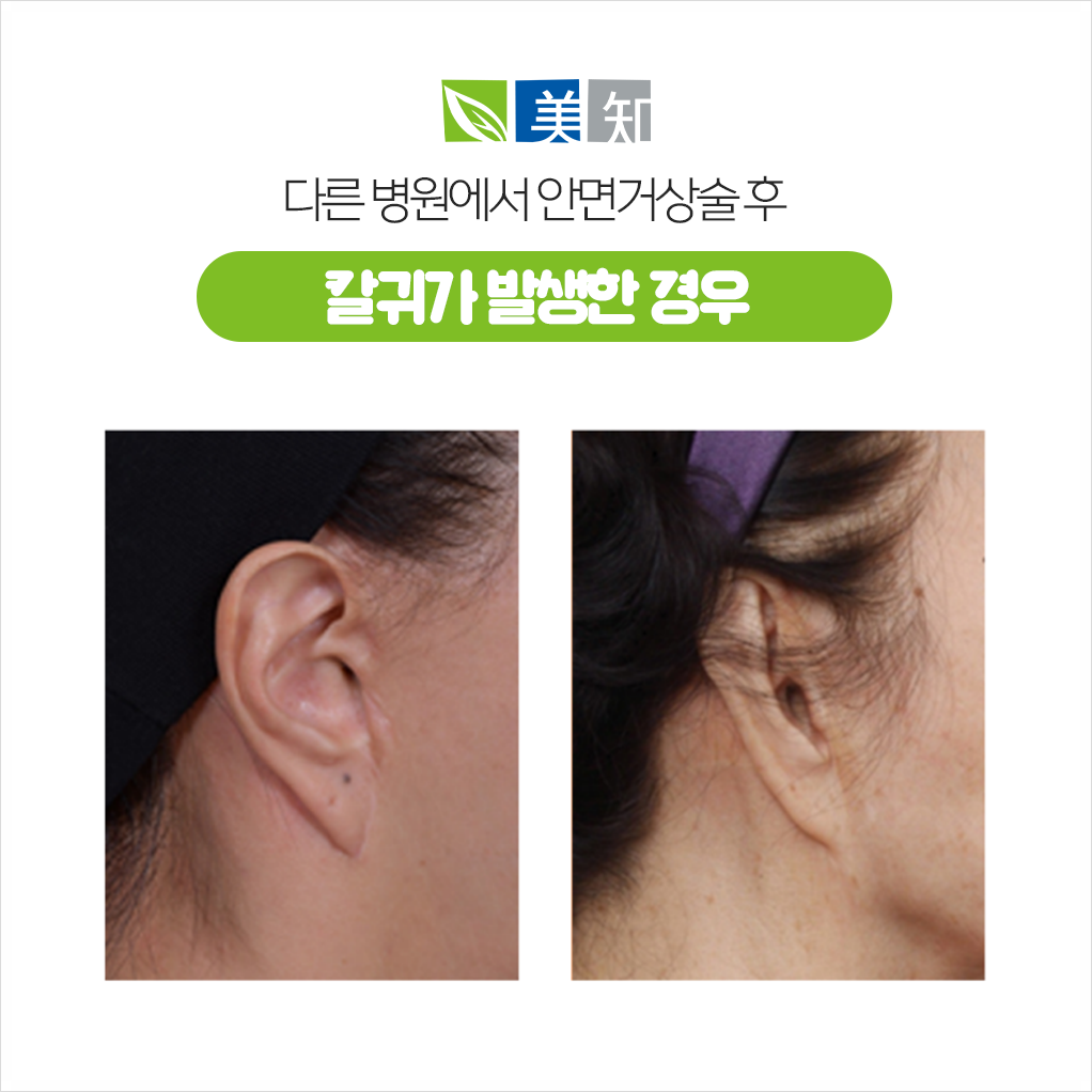 강남안면거상후칼귀