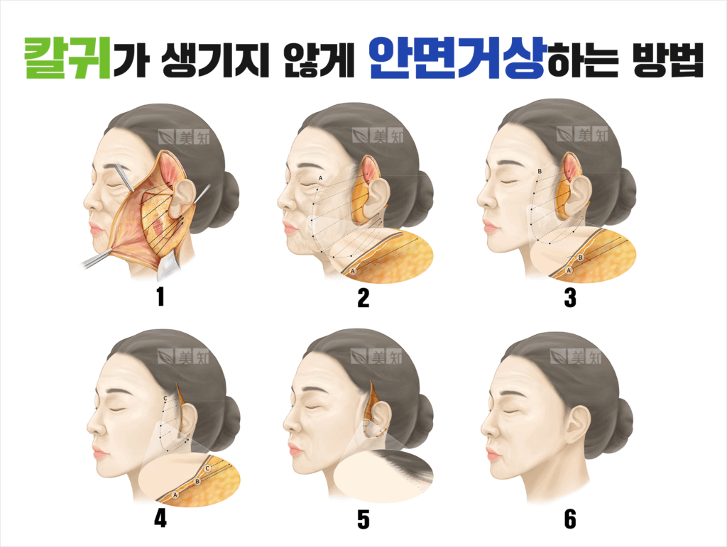 강남안면거상후칼귀