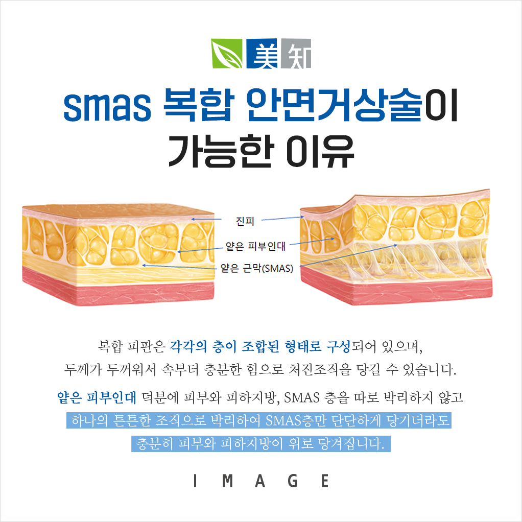안면거상처짐