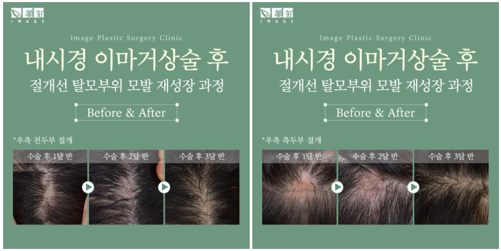 이마거상회복기간