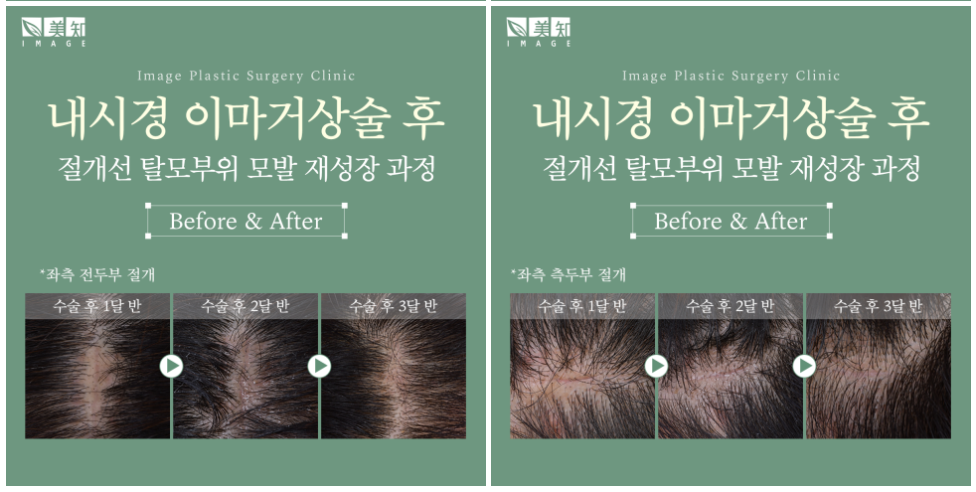 이마거상회복기간