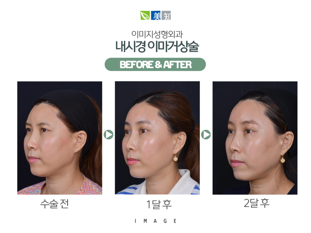 이마거상회복기간