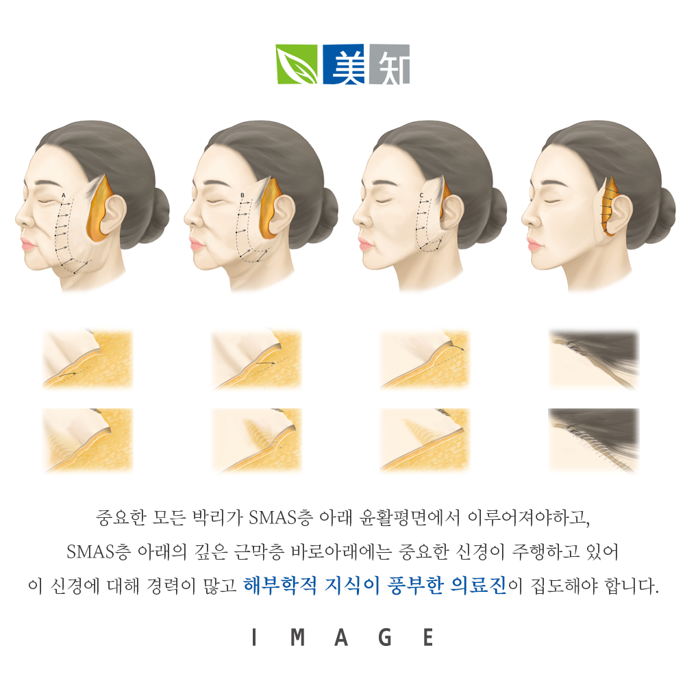 안면거상술잘하는곳