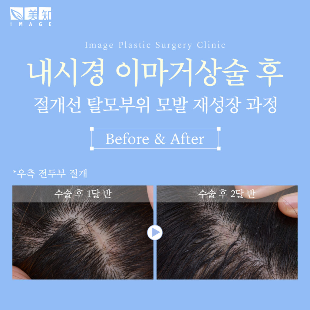 이마거상회복기간