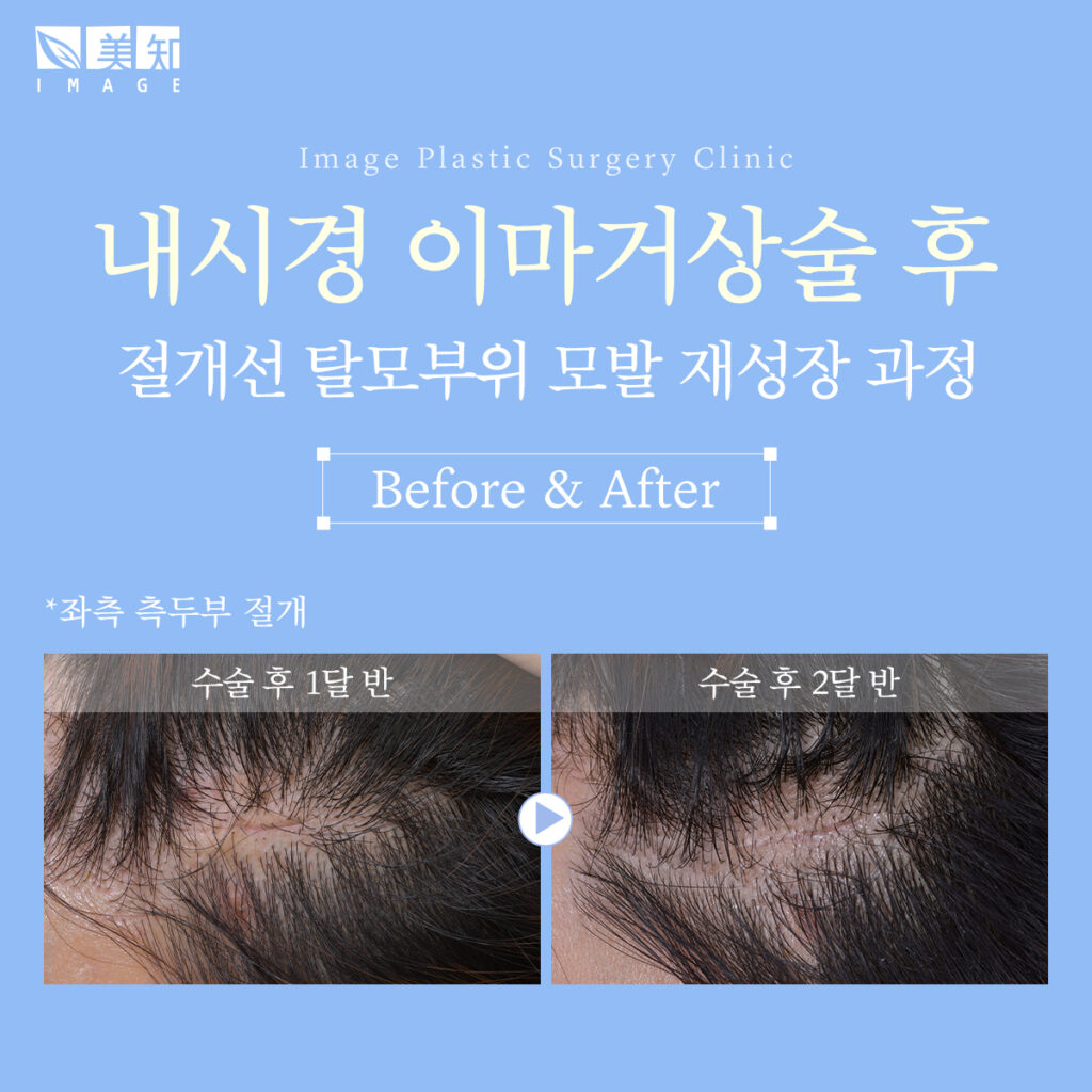 이마거상회복기간