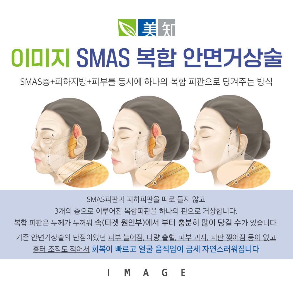 안면거상술