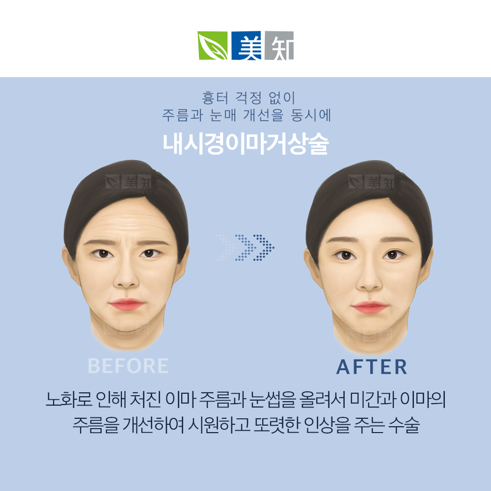 이마거상흉터