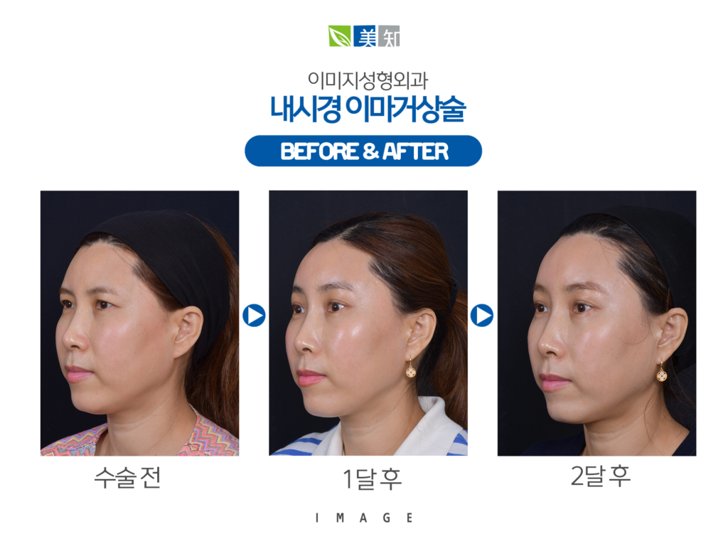 강남이마거상술