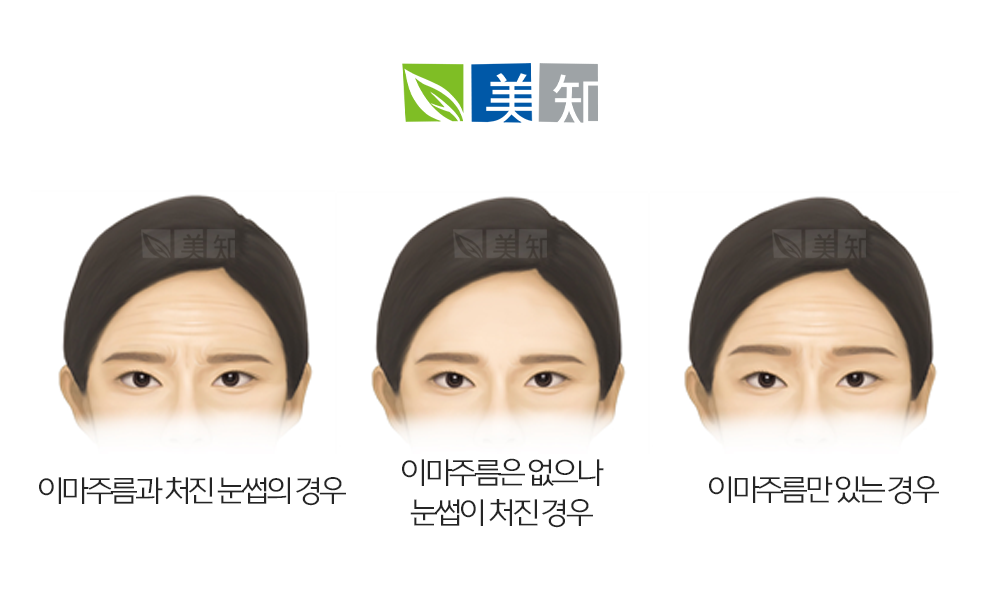 이마거상흉터