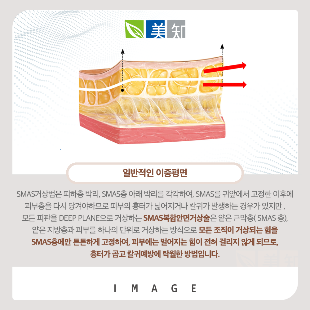 안면거상회복기간