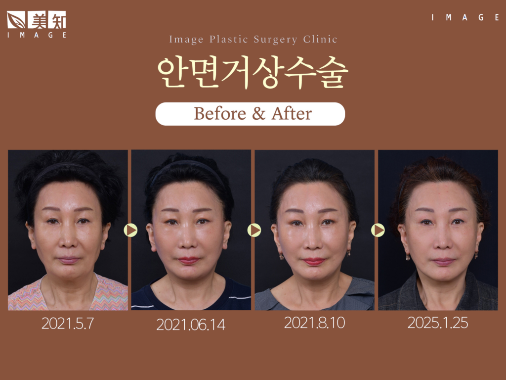 안면거상회복기간