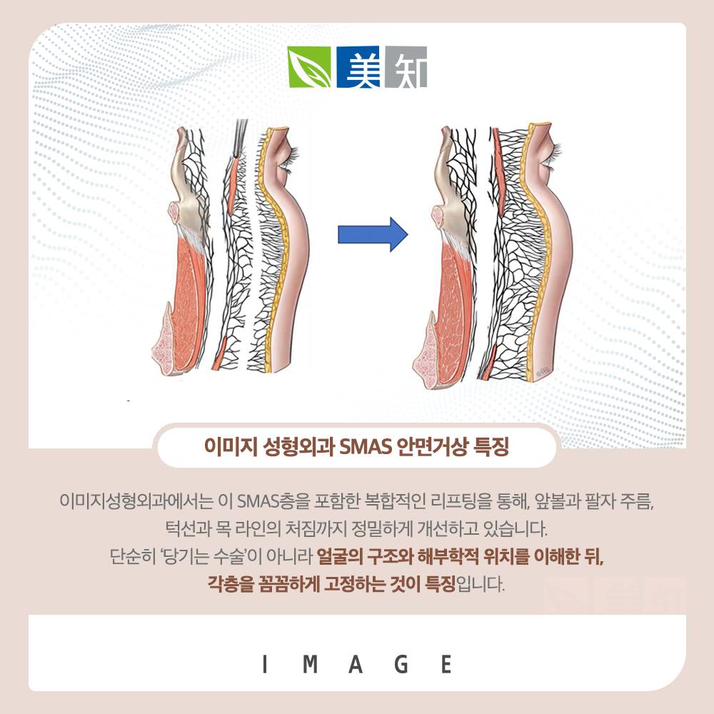 안면거상회복기간