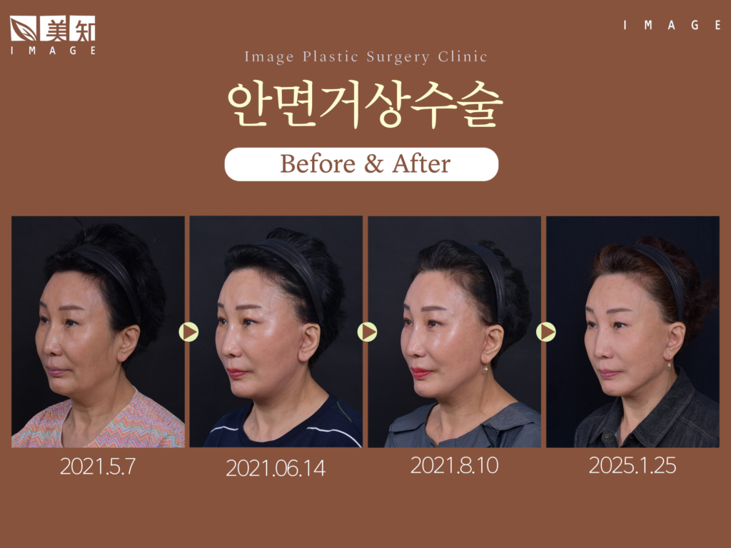 안면거상회복기간