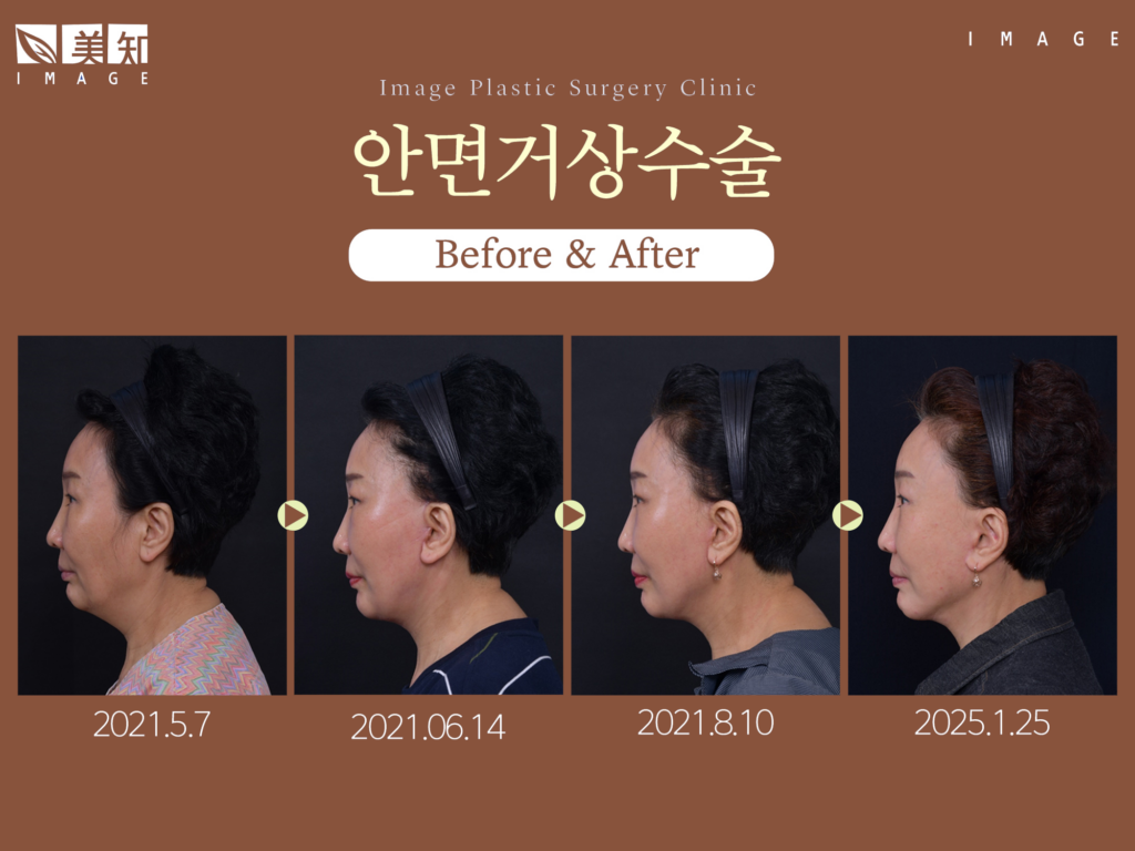 안면거상회복기간