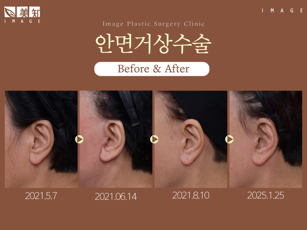 안면거상회복기간
