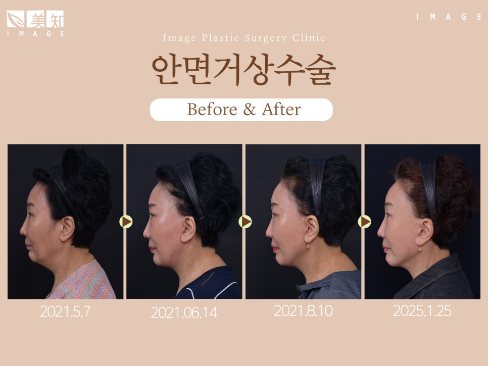 안면거상술잘하는곳 거울과 사진 속 낯선 얼굴선 수술 전 상담 고민 기준 확인